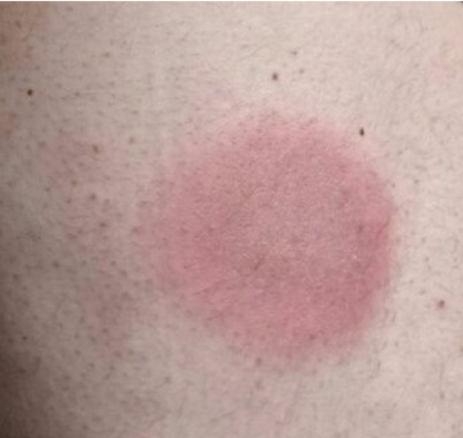 Rode vlek na tekenbeet is ook indicatie voor ziekte van Lyme (Bron: RIVM / Tekenradar.nl)